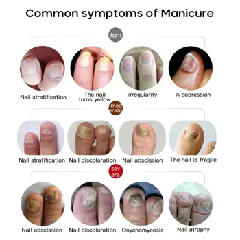 gropi în tratamentul ciupercii unghiilor vindeca mucegaiul pe unghiile de la picioare