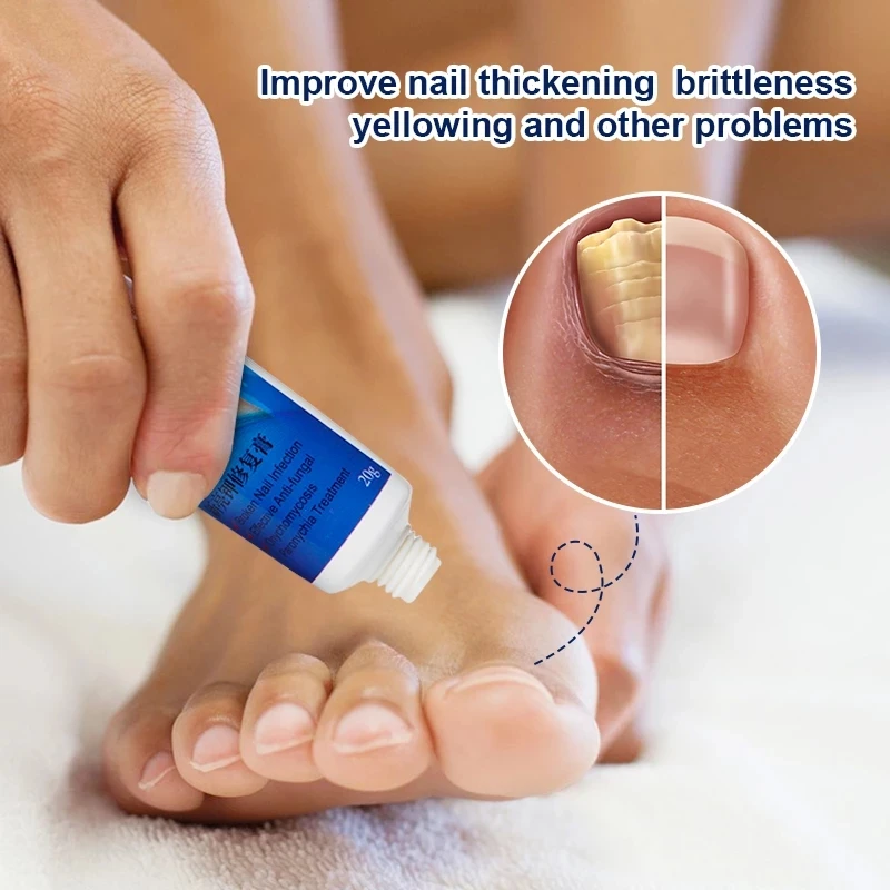 ciuperca unghiilor vă poate crăpa degetul de la picior