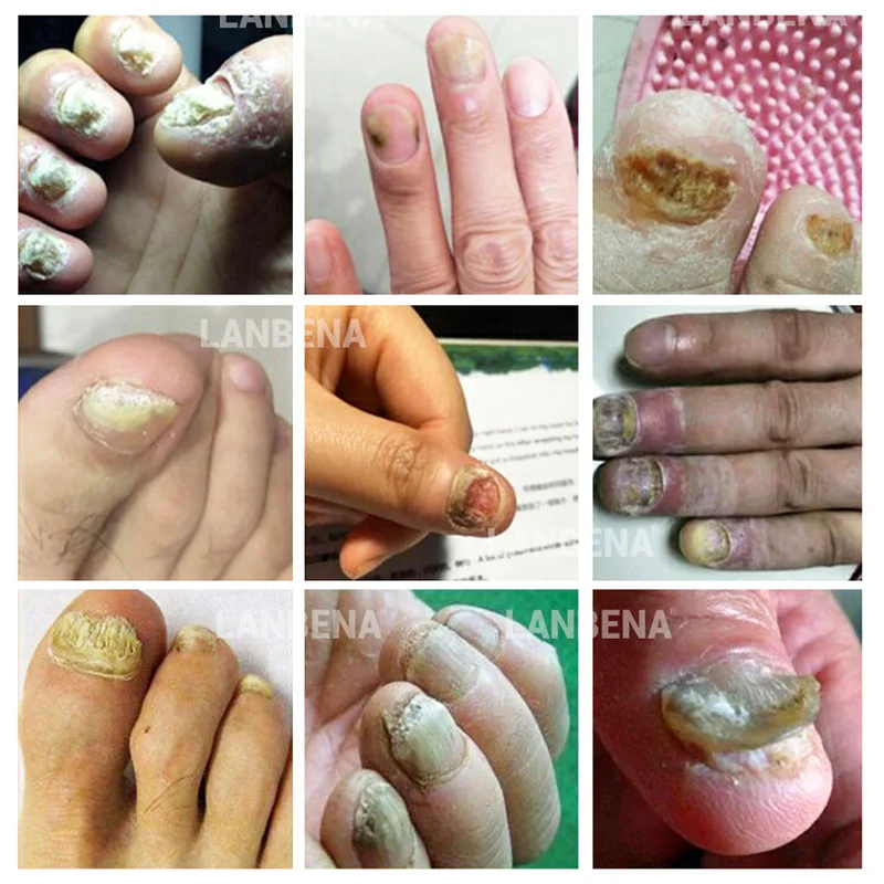 gropi în tratamentul ciupercii unghiilor vânătăi pe ciuperca unghiei degetului mare