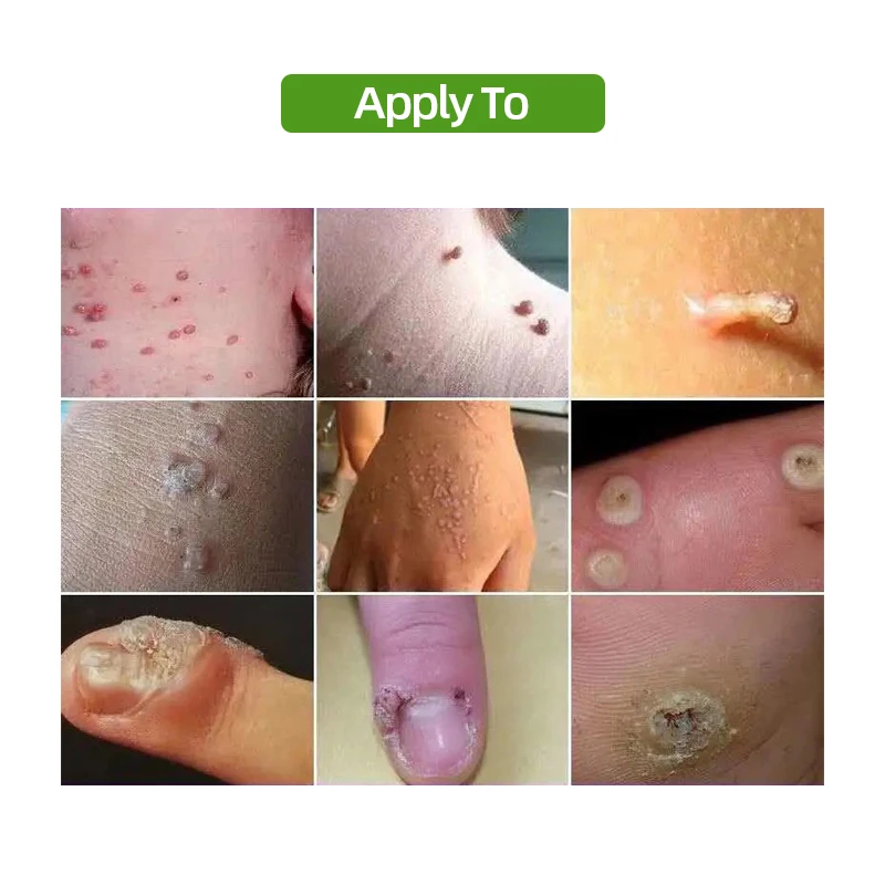 simptome ale condilomului uretral papillomavirus on skin